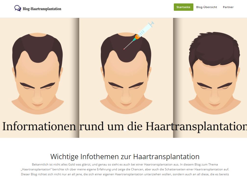 Matthias postet alles rund ums Thema „Haartransplantation“
