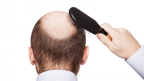 Ist Kreisrunder Haarausfall wirklich eine Autoimmunerkrankung 2.jpg