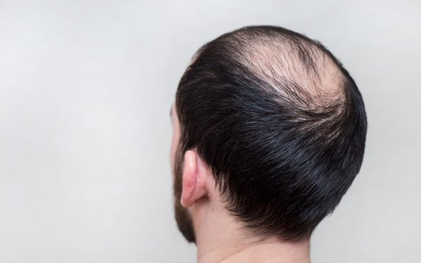 Ist Kreisrunder Haarausfall wirklich eine Autoimmunerkrankung.jpg