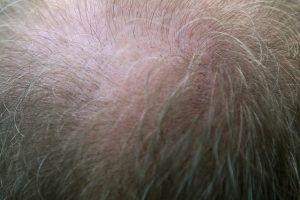 kreisrunder Haarausfall kreisrunder Haarausfall