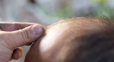 haartransplantation-in-deutschland-oder-im-ausland