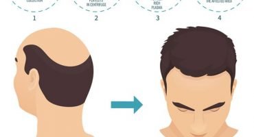 prp-behandlung-haare