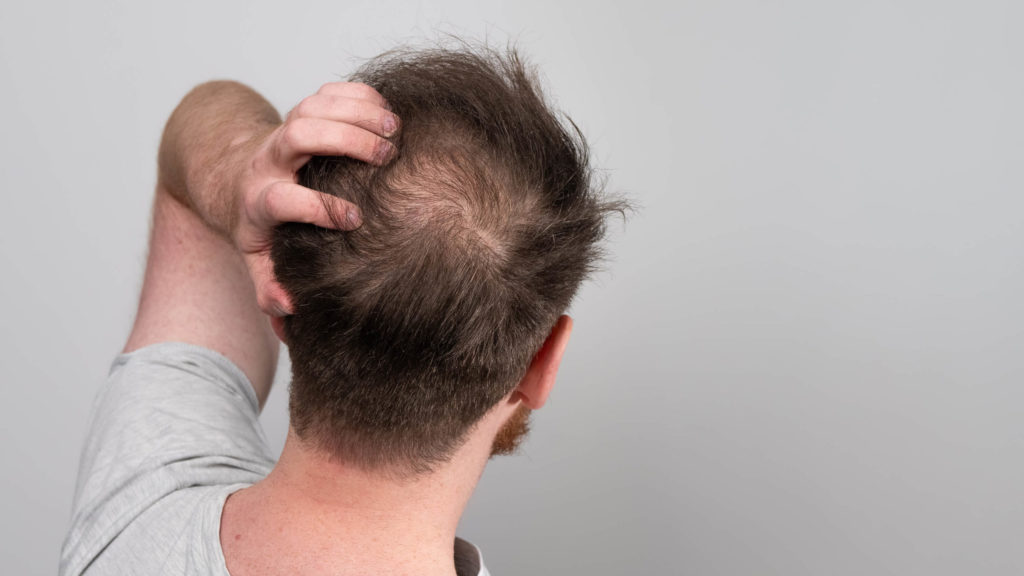 Creatin und Haarausfall Zusammenhang? » meinehaarklinik.de