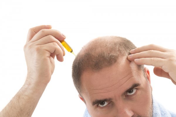 Behandlung gegen Haarausfall finden