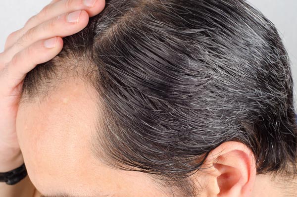 Haartransplantation-FUE-Technik-manuelle-Entnahme-gegen-Haarausfall