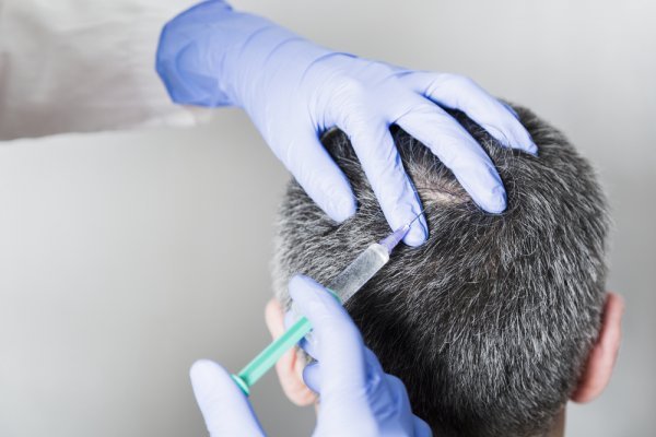 Haartransplantation PRP Behandlung
