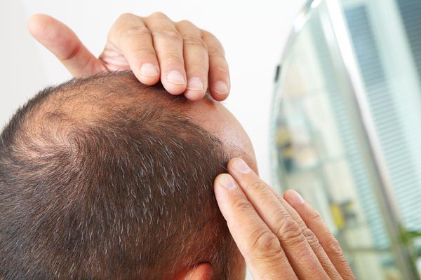 Haartransplantation bei Haarausfall Erfahrungen