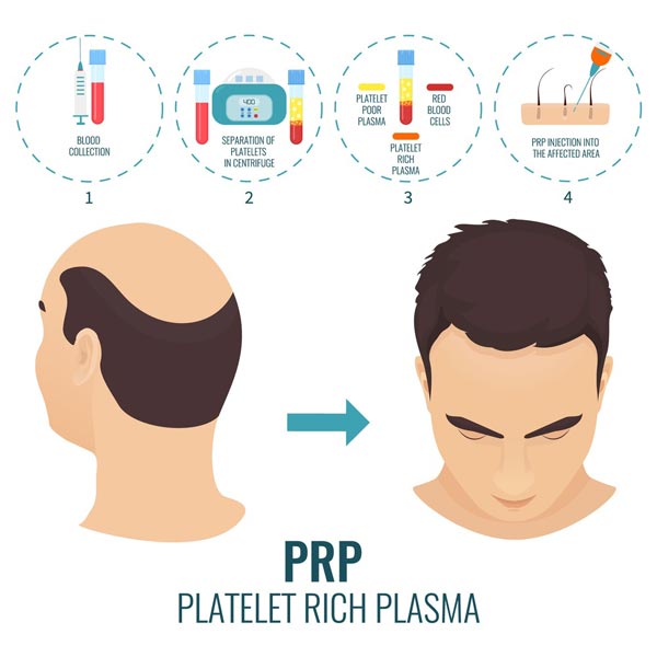 PRP-Behandlung-Haare-Haartransplantation-1