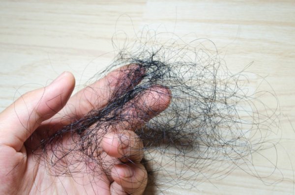genetisch bedingter haarausfall