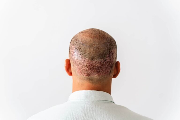 Creatin und Haarausfall Zusammenhang? » meinehaarklinik.de