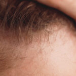 Haartransplantation Haare fallen aus – Ursachen und Tippsv
