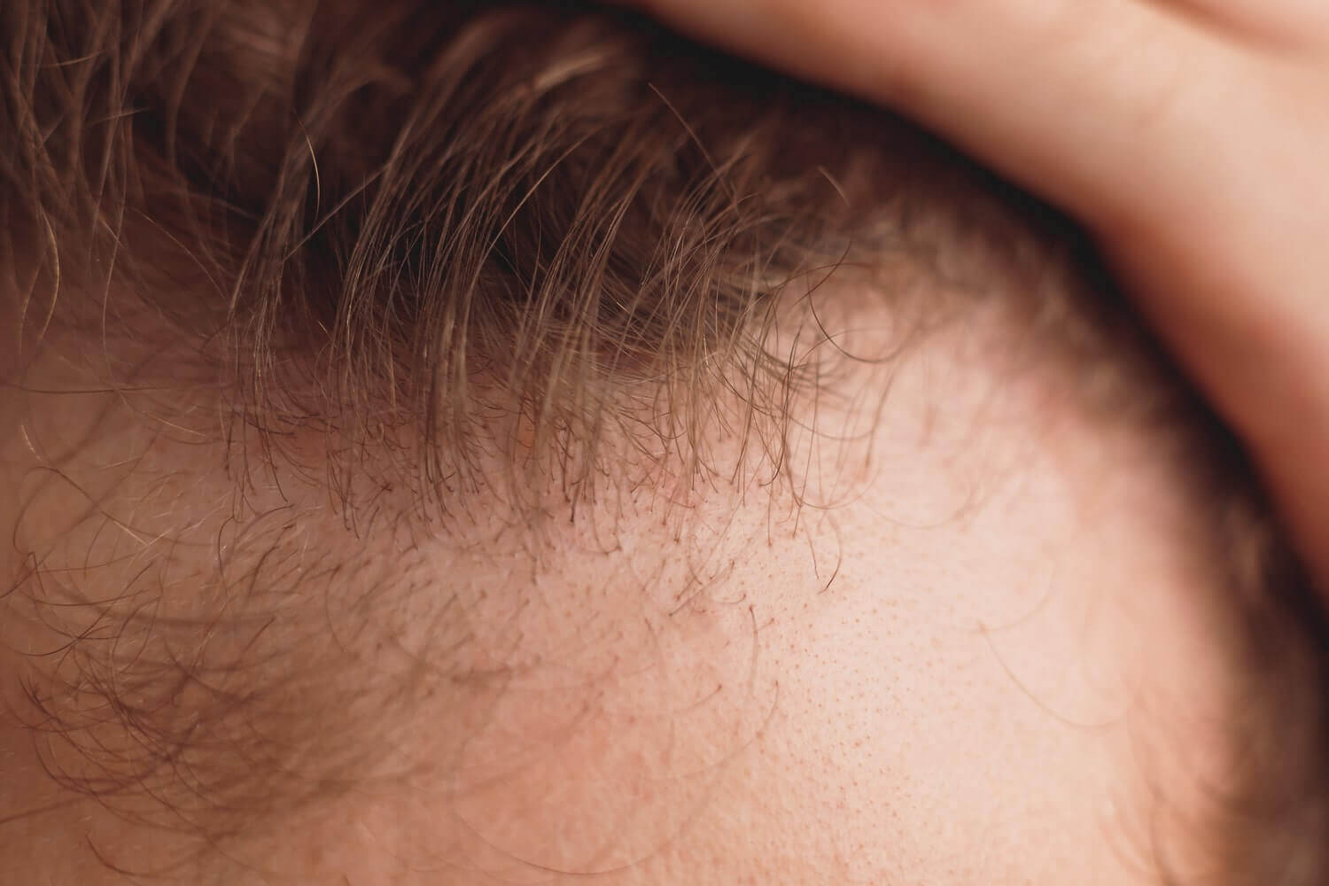 Haartransplantation Haare fallen aus – Ursachen und Tippsv