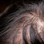 Haartransplantation nicht dicht genug – woran liegt es?