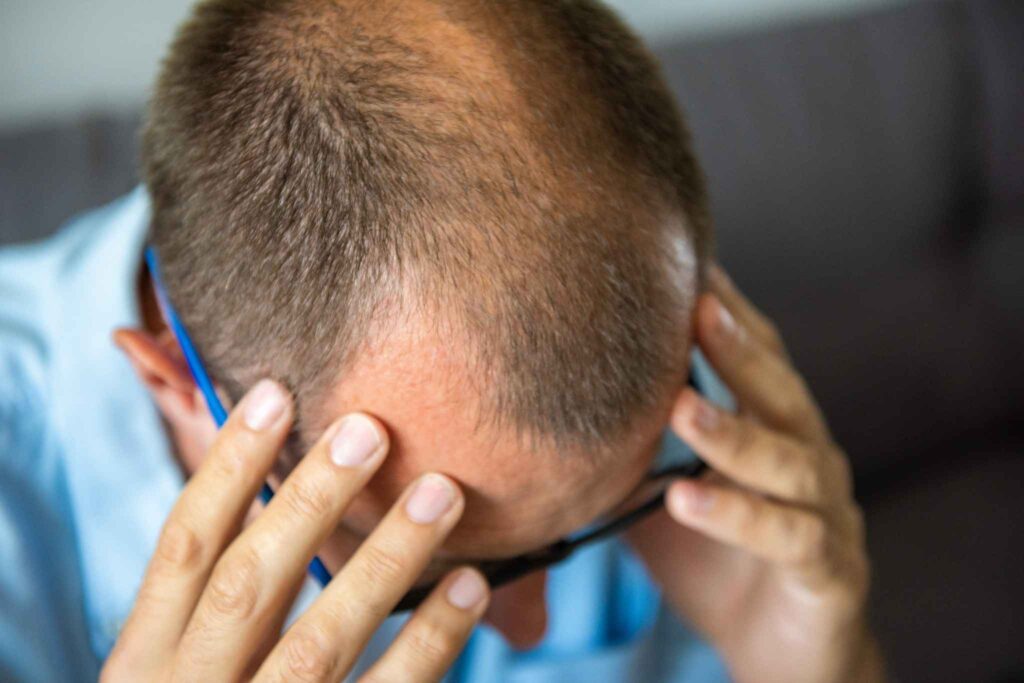 Haartransplantation nicht dicht genug-bei den geheimratsecken